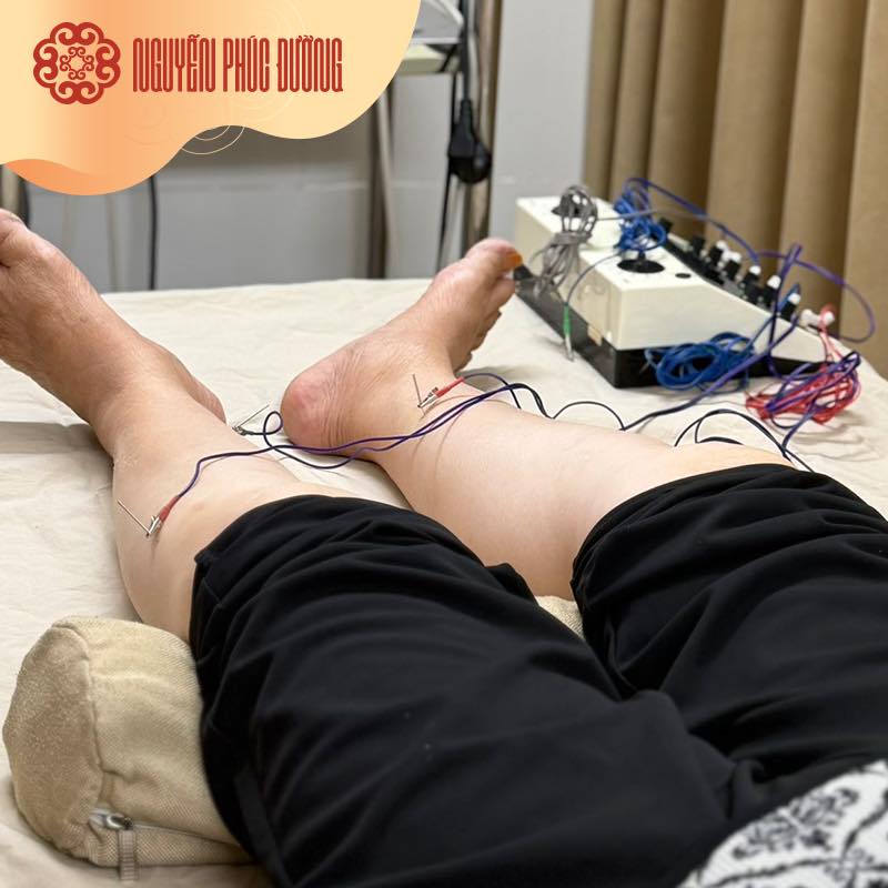 Giảm sưng đau chân do suy giãn tĩnh mạch