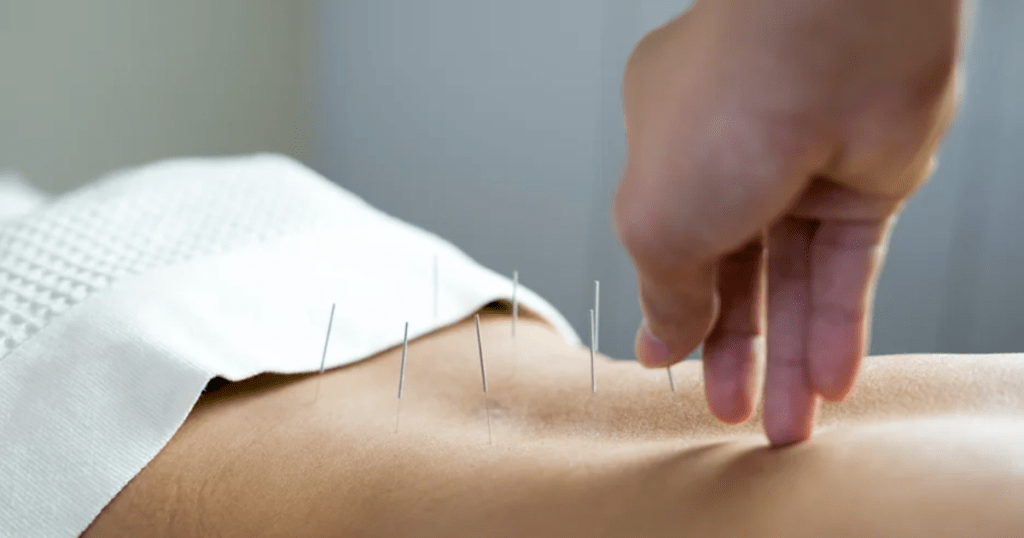 Hiệu quả của châm cứu kéo dài được bao lâu Đau thần kinh tọa có tái phát sau khi ngưng châm cứu