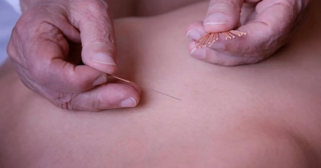 Châm cứu và cơ chế tác động lên hệ thần kinh trung ương