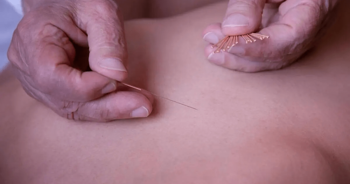 Châm cứu và cơ chế tác động lên hệ thần kinh trung ương