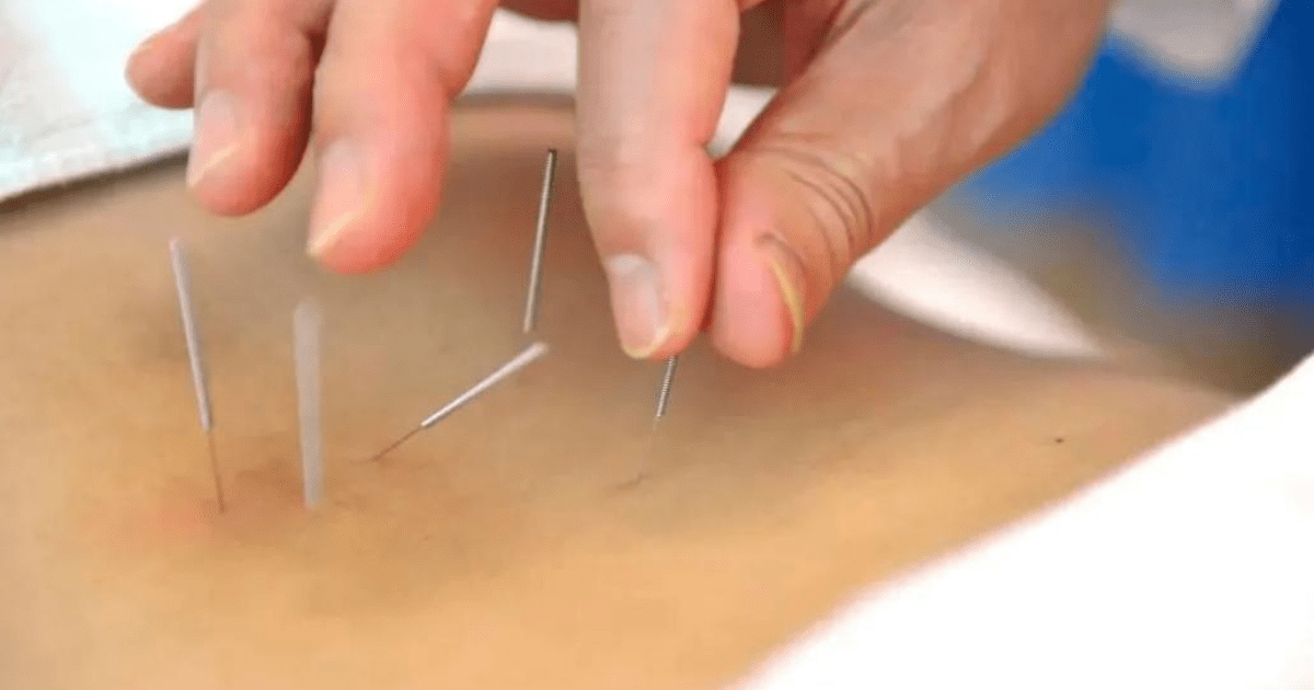 Vai trò của châm cứu trong điều hòa thần kinh