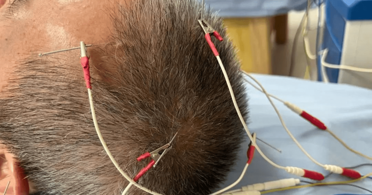 Châm cứu điều trị mất ngủ do stress, căng thẳng thần kinh