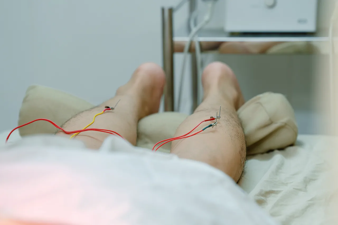 Hình ảnh điện châm vùng cẳng chân tại phòng khám